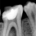 1 Granulomi apicali con infezione interradicolare