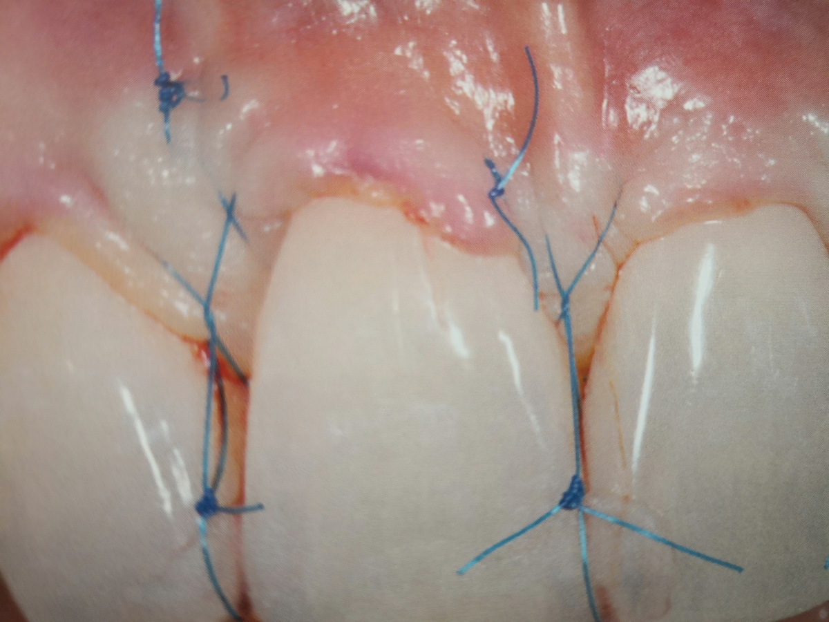 Rimozione suture dopo 2 settimane